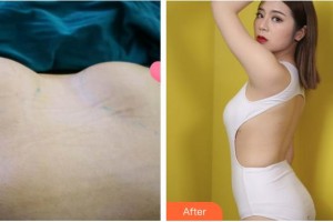 泉州市第一醫(yī)院整形美容外科李迫達(dá)整形價(jià)格表附自體脂肪隆胸案例展示