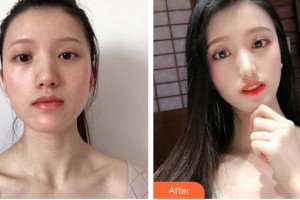 泉州解放軍第180醫(yī)院整形美容中心游龍標(biāo)整形價(jià)格表附蜂巢激光美膚祛斑案例展示