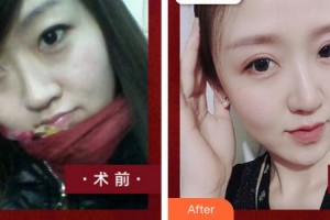 泉州海峽醫(yī)療美容醫(yī)院劉洋整形價(jià)格表附雙眼皮修復(fù)案例展示