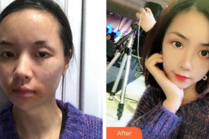 泉州歐菲醫(yī)療美容門診部饒嘉玲整形價(jià)格表附多方面部埋線提升案例展示