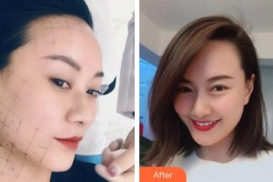 泉州歐菲醫(yī)療美容門診部方暖碩整形價(jià)格表附熱瑪吉案例展示