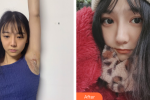 廣州愛來（原阿瑪施）醫(yī)療美容整形醫(yī)院肖大衛(wèi)整形價格表附腋臭疤痕案例展示