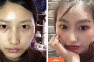 廣州鴻嘉怡美微整形醫(yī)院李靖雯整形價格表附全切雙眼皮案例展示