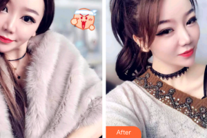 廣州醫(yī)學院口腔醫(yī)院歐陽可雄整形價格表附牙齒隱形矯正案例展示