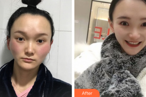 廣州麗尚整形美容門診部吳昌鉉整形價格表附顴骨顴弓案例展示