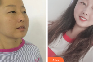 廣州麗尚整形美容門診部李小麗整形價格表附面部吸脂案例展示