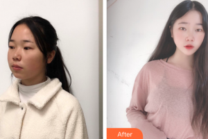 廣州麗尚整形美容門診部李安琪整形價格表附面部吸脂案例展示