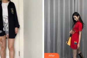 泉州美萊華美整形美容醫(yī)院范偉整形價(jià)格表附增生疤痕案例展示