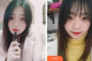 泉州西華醫(yī)療美容醫(yī)院盛瓊花整形價(jià)格表附牙齒隱形矯正案例展示