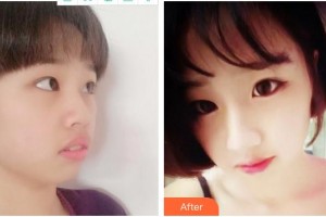 泉州億星醫(yī)療美容門診部秦念國整形價(jià)格表附隆鼻案例展示