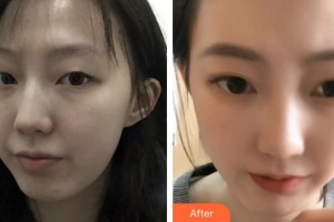 泉州億星醫(yī)療美容門診部張翼飛整形價(jià)格表附眼部綜合案例展示