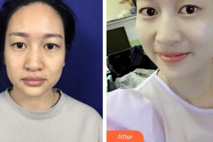 泉州億星醫(yī)療美容門診部葛海輝整形價(jià)格表附面部埋線提升案例展示