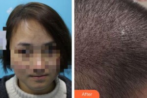 泉州歐菲醫(yī)療美容門診部夏瓊整形價(jià)格表附毛發(fā)移植案例展示