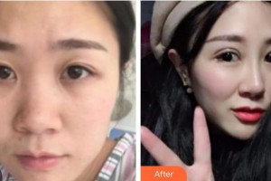 泉州海峽醫(yī)療美容醫(yī)院陳麗平整形價(jià)格表附綜合美眼案例展示