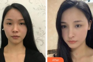 泉州美萊華美醫(yī)療美容門診部楊和強(qiáng)整形價(jià)格表附鼻部手術(shù)案例展示