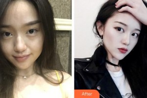 泉州西華醫(yī)療美容醫(yī)院陳世明整形價(jià)格表附面部年輕化案例展示