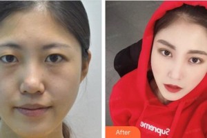 泉州美萊華美醫(yī)療美容門診部宋凡偉整形價(jià)格表附眼部綜合案例展示