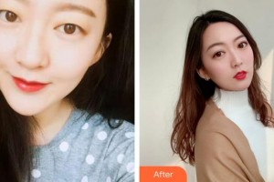 泉州海峽醫(yī)療美容醫(yī)院盧燕云整形價(jià)格表附眼部綜合案例展示