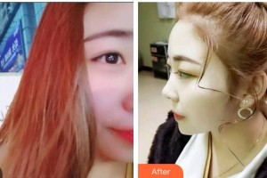 泉州泉興口腔門診部惠雯婷整形價(jià)格表附超聲波潔牙案例展示