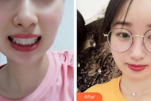 泉州泉興口腔門診部張春陽整形價(jià)格表附牙齒隱形矯正案例展示