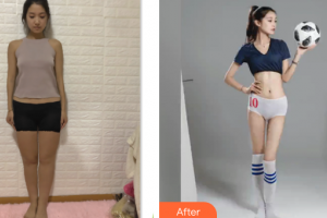 廣州法思脂肪移植醫(yī)學美容醫(yī)院李越整形價格表附腰腹環(huán)吸+大小腿吸脂案例展示