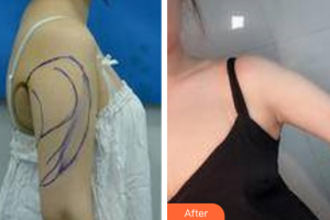 廣州法思脂肪移植醫(yī)學美容醫(yī)院胡榮軍整形價格表附手臂吸脂案例展示