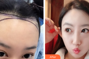 廣州雍禾植發(fā)門診部王傳凱整形價格表附發(fā)際線種植案例展示