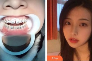 泉州貝臣口腔門診部鄧祺整形價(jià)格表附門縫妹變牙計(jì)案例展示