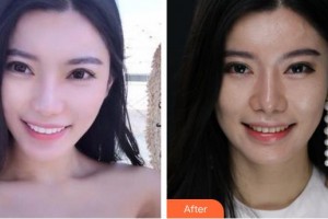 泉州維樂口腔門診部謝燕峰整形價(jià)格表附瓷貼面案例展示