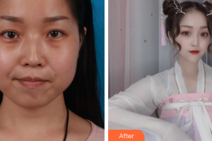 廣州壹加壹美容醫(yī)院甘泉涌整形價格表附下頜角+下頦前移案例展示