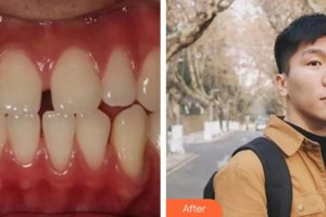 泉州維樂口腔門診部王燕燕整形價(jià)格表附金屬托槽矯正案例展示