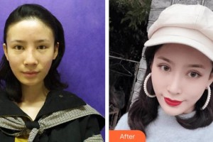 泉州愛爾眼科醫(yī)院李貴洲整形價(jià)格表附經(jīng)典切開雙眼皮案例展示