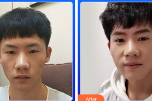 廣州博仕整形美容醫(yī)院劉洋整形價格表附切開雙眼皮案例展示