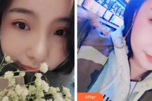 漳州佳美口腔門診部楊艷萍整形價格表附牙齒隱形矯正案例展示