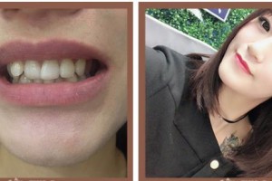 漳州佳美口腔門診部柯佳福整形價格表附隱形牙齒矯正案例展示