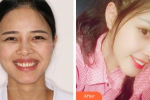 漳州佳美口腔門診部張亞群整形價格表附超薄牙貼面案例展示