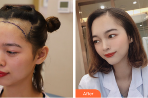 廣州雍禾植發(fā)門診部汪軍整形價格表附種植發(fā)際線案例展示