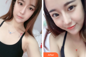 廣州伊麗莎白醫(yī)學美容門診部明皓整形價格表附自體脂肪隆胸案例展示