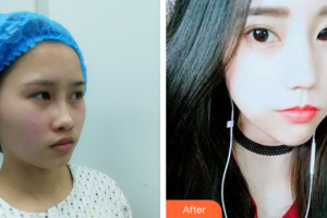 廣州柏美醫(yī)學美容醫(yī)院Jackyxu整形價格表附埋線提升案例展示