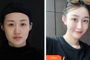 廣州凱美達整形美容醫(yī)院周玲整形價格表附熱瑪吉抗衰案例展示