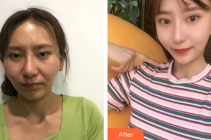 廣州拜博醫(yī)療美容門診部薛國初整形價格表附顴骨顴弓整形案例展示