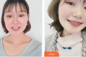 漳州佳美口腔門診部游玉玲整形價格表附牙綜合案例展示