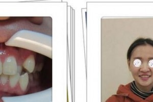 漳州佳美口腔門診部張健整形價格表附牙齒矯正案例展示