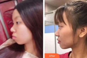 漳州佳美口腔門診部劉挺整形價格表附金屬托槽矯正案例展示