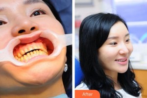 漳州佳美口腔門診部周東江整形價(jià)格表附冷光美白案例展示