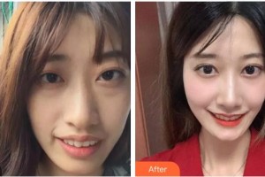 漳州衛(wèi)生職業(yè)學(xué)院附屬口腔醫(yī)院安厚鵬整形價(jià)格表附牙齒矯正案例展示