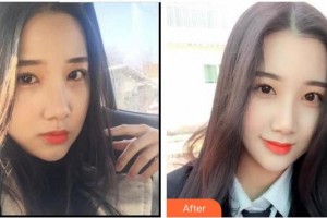 漳州衛(wèi)生職業(yè)學(xué)院附屬口腔醫(yī)院周曉琴整形價(jià)格表附冷光美白案例展示