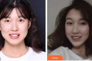 漳州南健口腔門診部劉明廣整形價(jià)格表附隱形托槽矯正案例展示