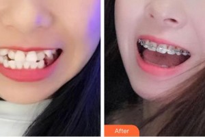 漳州南健口腔門診部呂彩華整形價(jià)格表附全齒金屬矯正案例展示