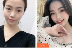 漳州眼科醫(yī)院羅添場(chǎng)整形價(jià)格表附雙眼皮案例展示